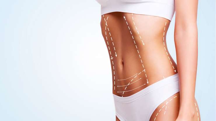 Κοιλιοπλαστική